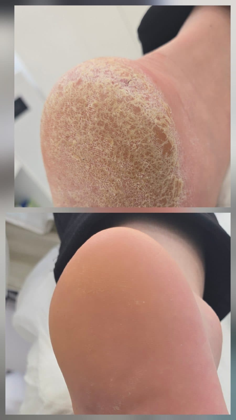 발각질을 부드럽게 정돈한 케어 이미지