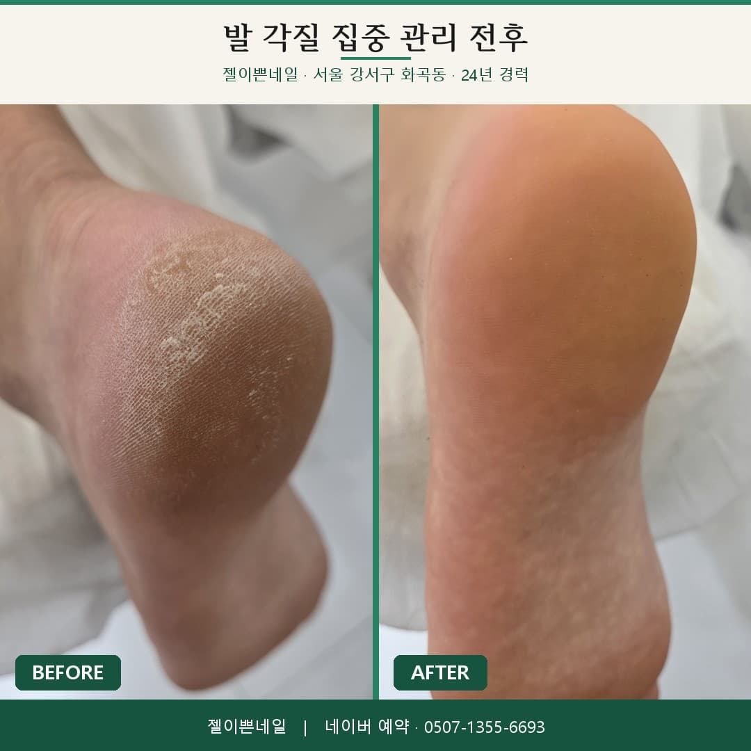 강서구 화곡동 젤이쁜네일 발뒤꿈치 각질 집중 관리 전후 비교 사진