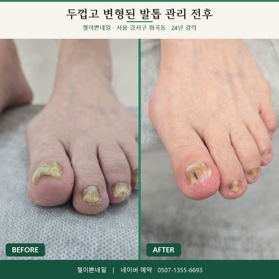 화곡동 젤이쁜네일에서 두껍고 누렇게 변한 발톱 여러 개를 정돈한 관리 전후 비교 사진
