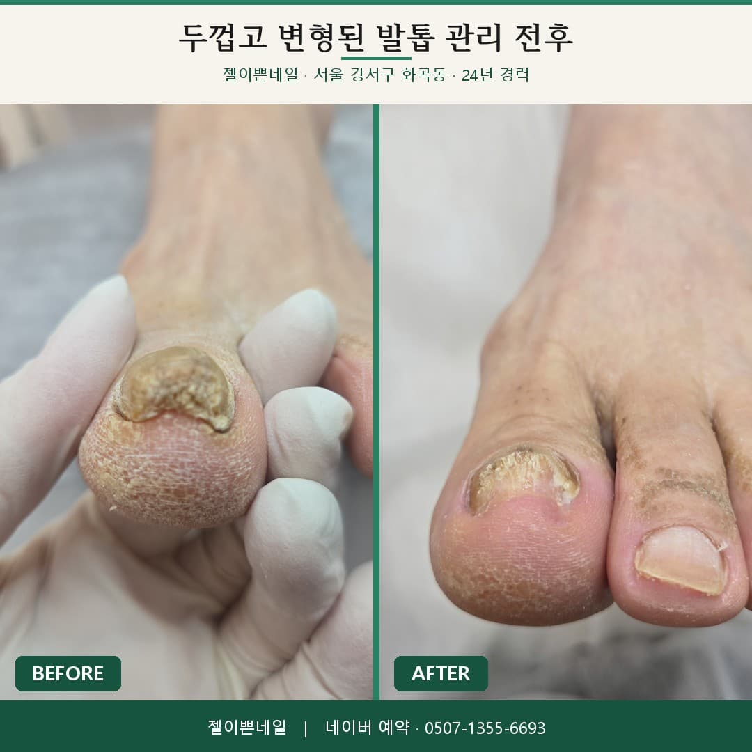 서울 강서구 화곡동 젤이쁜네일에서 두껍고 변형된 엄지발톱을 정돈한 관리 전후 비교 사진